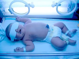 نحوه کارکرد دستگاه زردی نوزاد